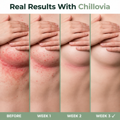 Chillovia Intertrigo Relief Cream