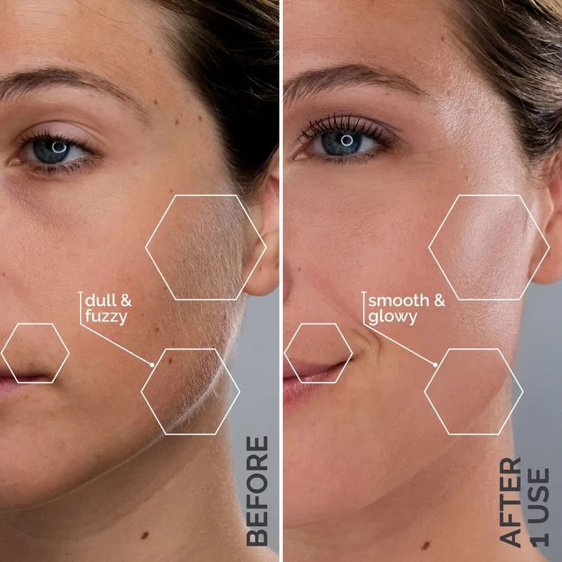 Chillovia™ Sonic Dermaplaning Pro